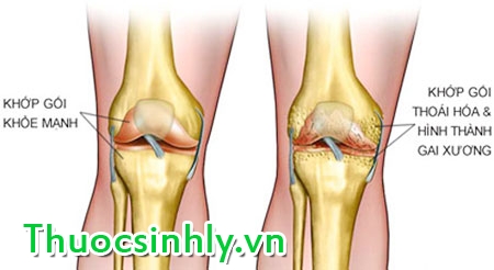 nguyen-nhan-gay-dau-khop-goi