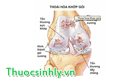 thoai-hoa-xuong-khop thoai-hoa-xuong-khop