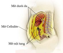 Để giảm béo, ta cần phải đào thải lớp mỡ nào trong cơ thể ?