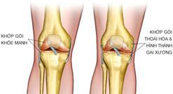 Nguyên nhân đau khớp gối cần biết